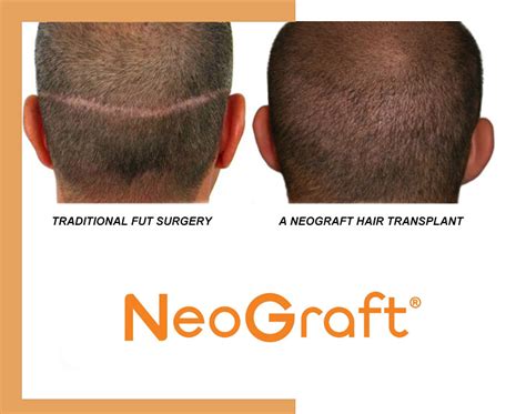 neograft hair transplants st louis|Hair Transplantation St. Louis .